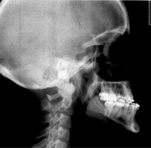 Pre-op x-ray