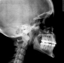 Post-op x-ray